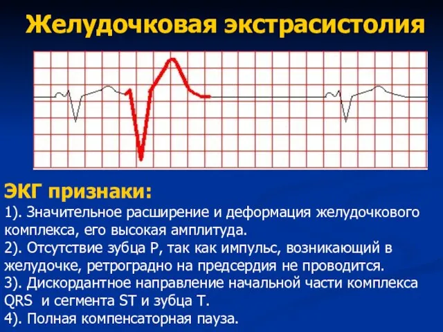 Желудочковая экстрасистолия ЭКГ признаки: 1). Значительное расширение и деформация желудочкового комплекса, его