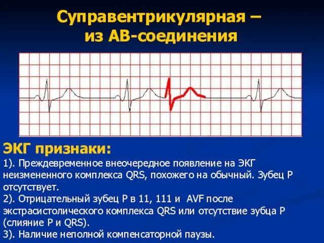 Суправентрикулярная – из АВ-соединения ЭКГ признаки: 1). Преждевременное внеочередное появление на ЭКГ