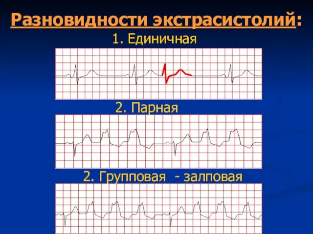 Разновидности экстрасистолий: 1. Единичная 2. Парная 2. Групповая - залповая