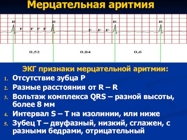 Мерцательная аритмия ЭКГ признаки мерцательной аритмии: Отсутствие зубца Р Разные расcтояния от