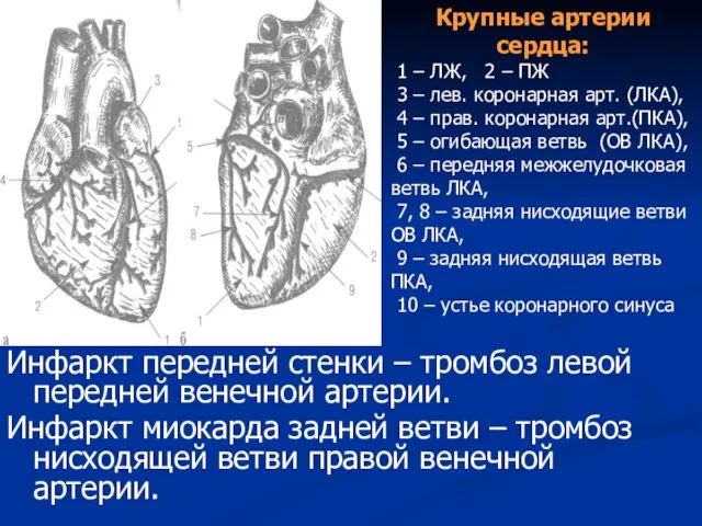 Инфаркт передней стенки – тромбоз левой передней венечной артерии. Инфаркт миокарда задней