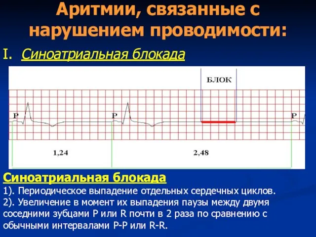 Аритмии, связанные с нарушением проводимости: I. Синоатриальная блокада Синоатриальная блокада 1). Периодическое