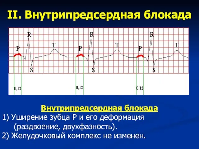 II. Внутрипредсердная блокада Внутрипредсердная блокада 1) Уширение зубца Р и его деформация