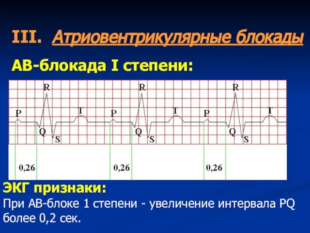 III. Атриовентрикулярные блокады АВ-блокада I степени: ЭКГ признаки: При АВ-блоке 1 степени