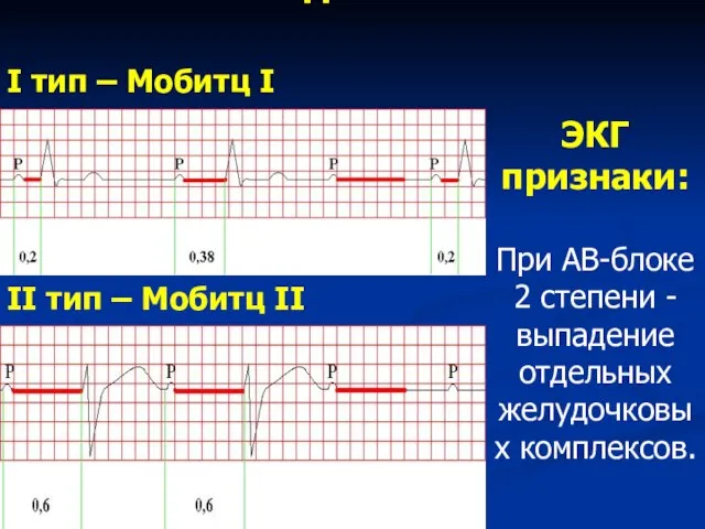 АВ-блокада II степени: I тип – Мобитц I II тип – Мобитц