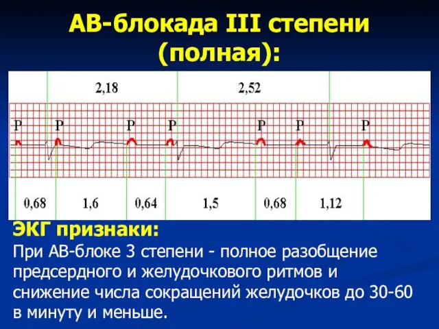 АВ-блокада III степени (полная): ЭКГ признаки: При АВ-блоке 3 степени - полное