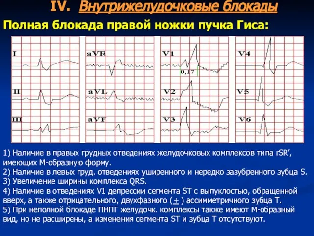 IV. Внутрижелудочковые блокады Полная блокада правой ножки пучка Гиса: 1) Наличие в