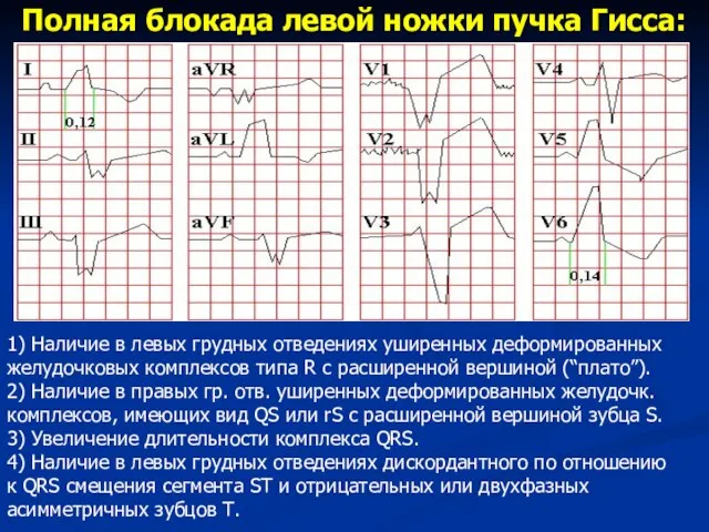 Полная блокада левой ножки пучка Гисса: 1) Наличие в левых грудных отведениях