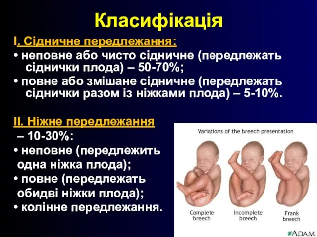 Класифікація I. Сідничне передлежання: • неповне або чисто сідничне (передлежать сіднички плода)