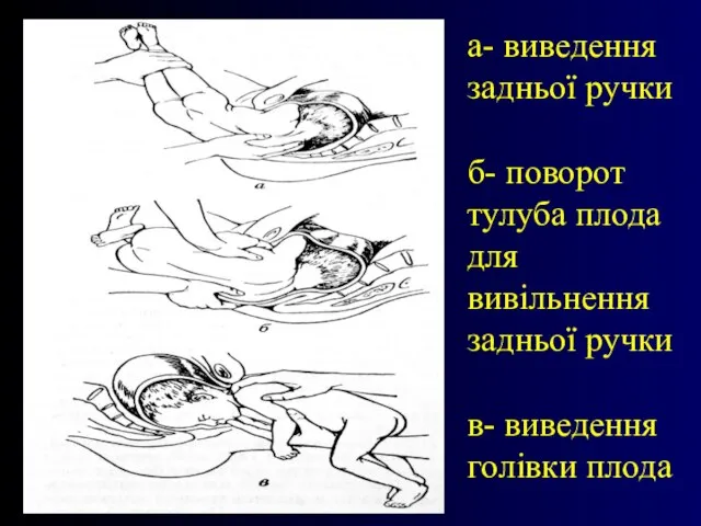 а- виведення задньої ручки б- поворот тулуба плода для вивільнення задньої ручки в- виведення голівки плода