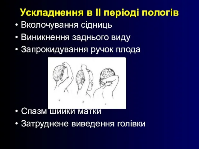 Ускладнення в ІІ періоді пологів Вколочування сідниць Виникнення заднього виду Запрокидування ручок