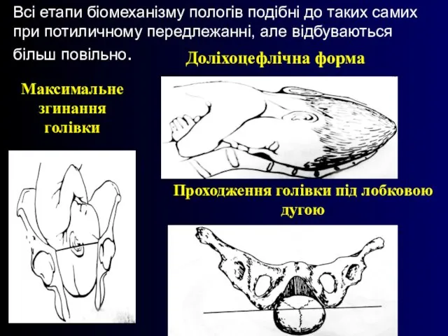 Всі етапи біомеханізму пологів подібні до таких самих при потиличному передлежанні, але