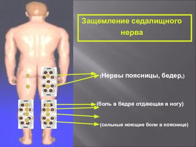 Защемление седалищного нерва (Нервы поясницы, бедер,) (боль в бедре отдающая в ногу)