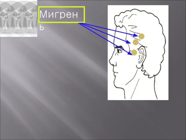 Мигрень