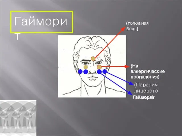 Гайморит (Не аллергические воспаления) Гайморит 2구 (головная боль) (Паралич лицевого нерва) 2구 2구