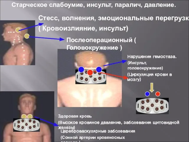 Старческое слабоумие, инсульт, паралич, давление. Стесс, волнения, эмоциональные перегрузки. ( Кровоизлияние, инсульт)