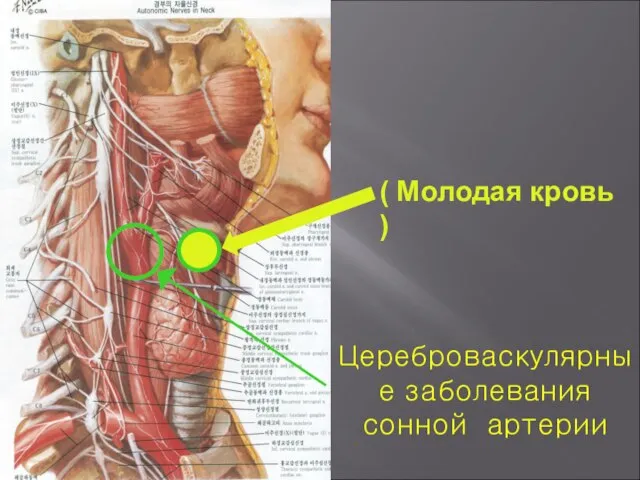 Цереброваскулярные заболевания сонной артерии ( Молодая кровь )