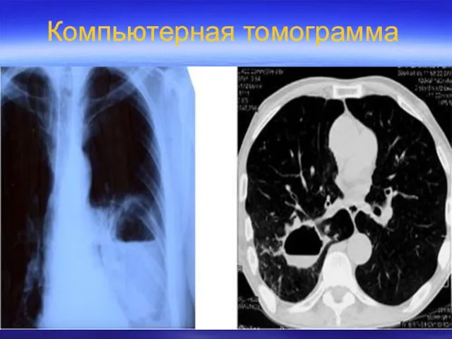 Компьютерная томограмма