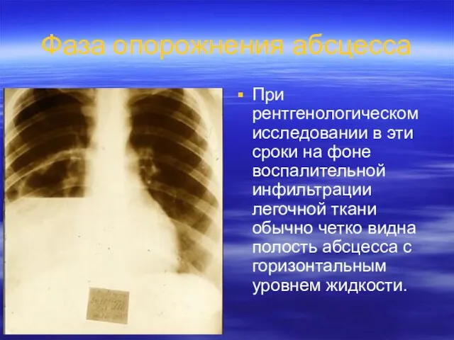 Фаза опорожнения абсцесса При рентгенологическом исследовании в эти сроки на фоне воспалительной