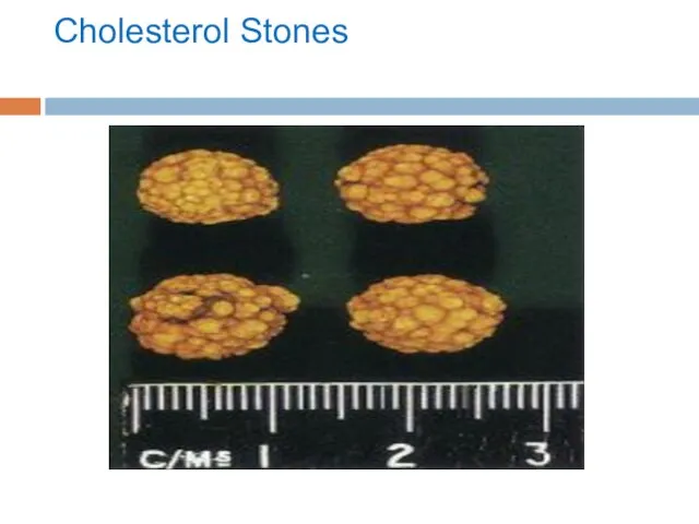 Cholesterol Stones