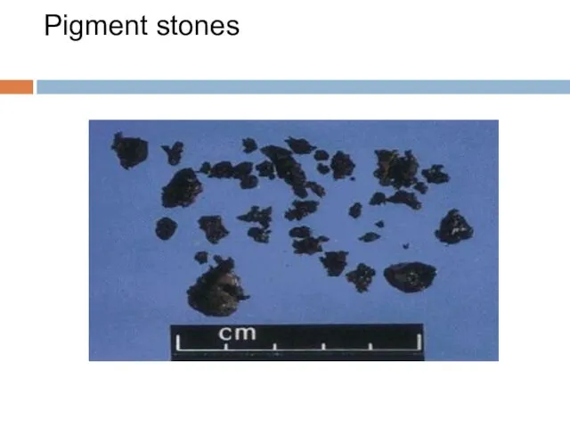 Pigment stones