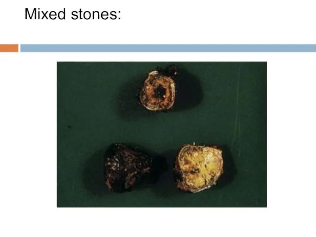 Mixed stones: