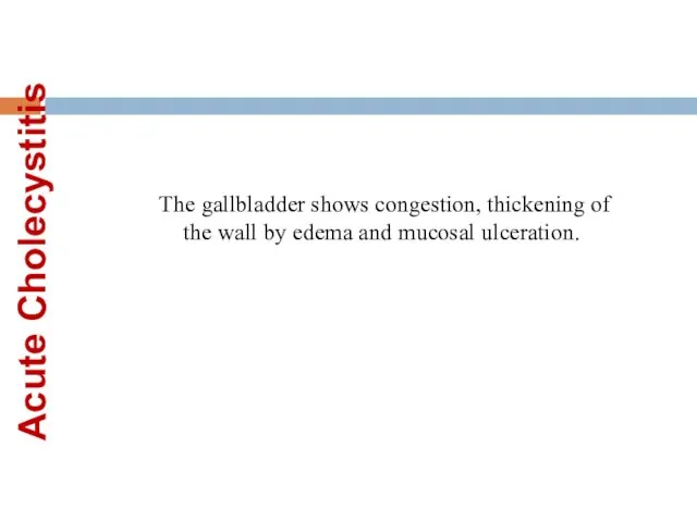 Acute Cholecystitis The gallbladder shows congestion, thickening of the wall by edema and mucosal ulceration.