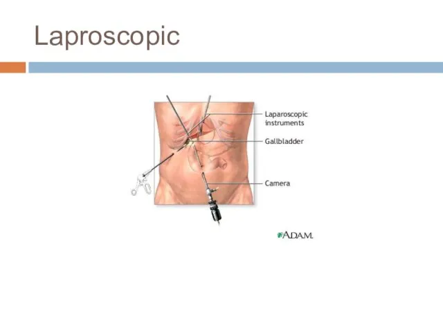 Laproscopic