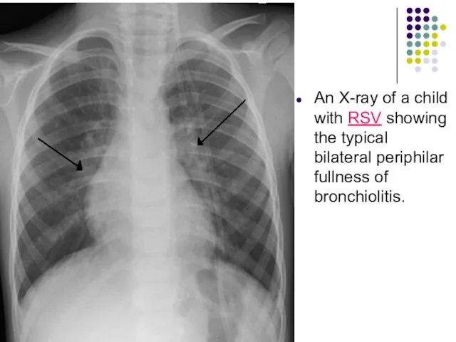 An X-ray of a child with RSV showing the typical bilateral periphilar fullness of bronchiolitis.