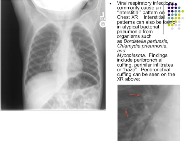 Viral respiratory infections commonly cause an “interstitial” pattern on Chest XR. Interstitial