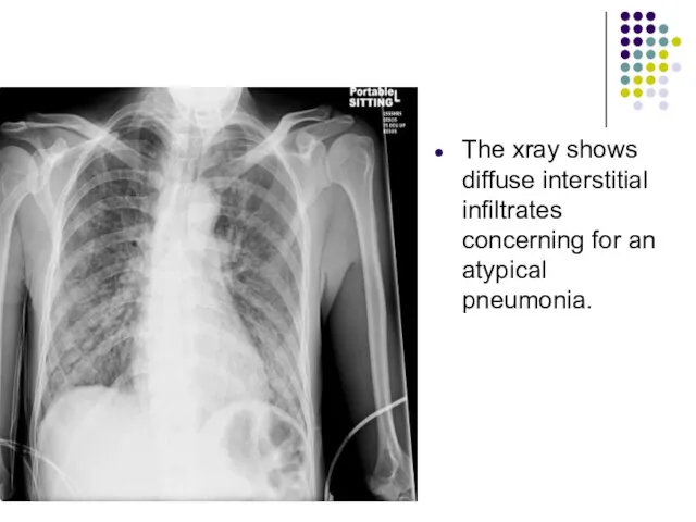 The xray shows diffuse interstitial infiltrates concerning for an atypical pneumonia.