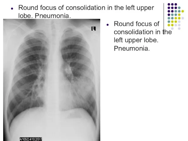 Round focus of consolidation in the left upper lobe. Pneumonia. Round focus