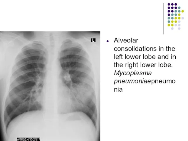 Alveolar consolidations in the left lower lobe and in the right lower lobe. Mycoplasma pneumoniaepneumonia