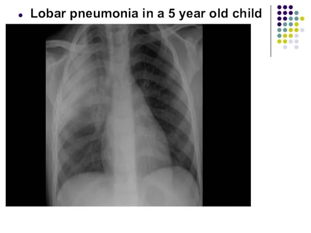 Lobar pneumonia in a 5 year old child