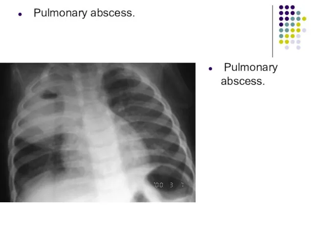 Pulmonary abscess. Pulmonary abscess.