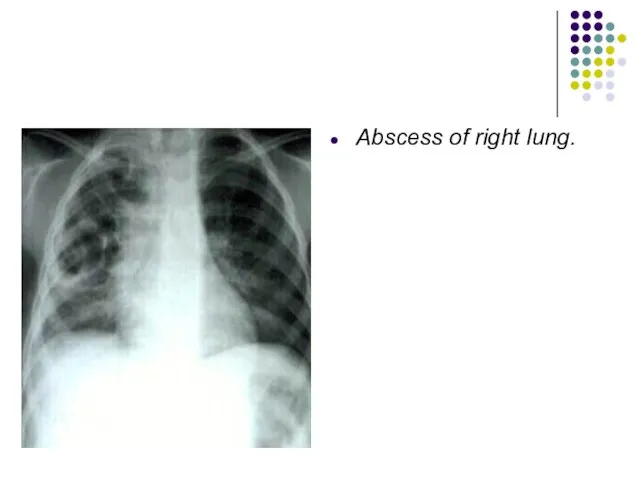 Abscess of right lung.