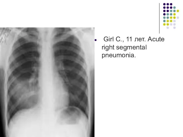 Girl С., 11 лет. Acute right segmental pneumonia.