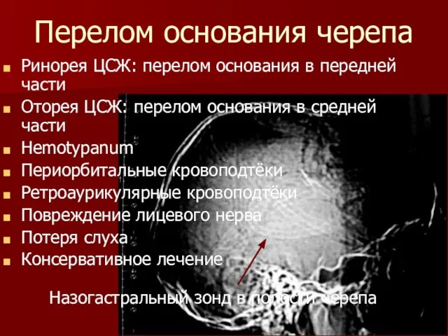 Перелом основания черепа Ринорея ЦСЖ: перелом основания в передней части Оторея ЦСЖ: