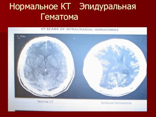 Нормальное КТ Эпидуральная Гематома