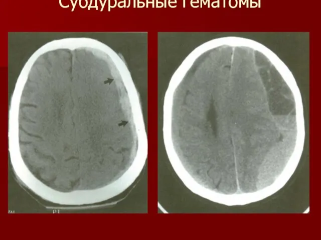 Субдуральные гематомы