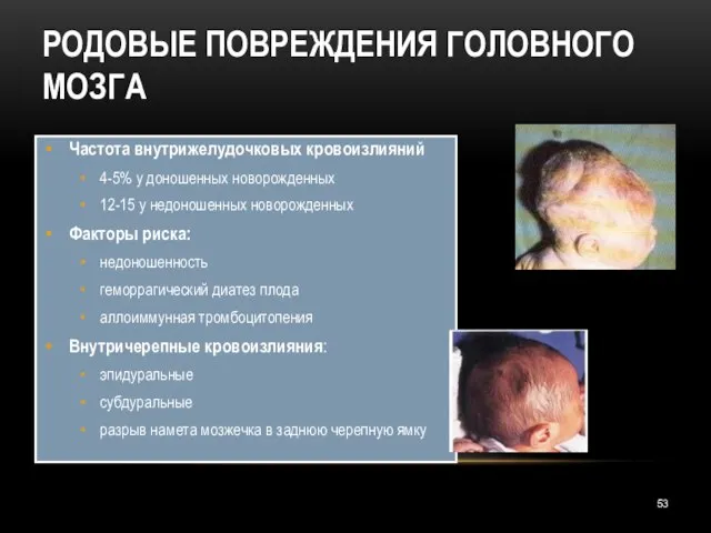 РОДОВЫЕ ПОВРЕЖДЕНИЯ ГОЛОВНОГО МОЗГА Частота внутрижелудочковых кровоизлияний 4-5% у доношенных новорожденных 12-15