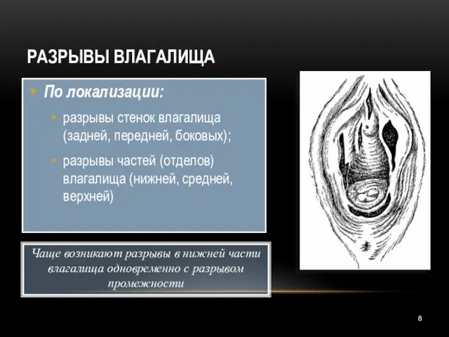 РАЗРЫВЫ ВЛАГАЛИЩА По локализации: разрывы стенок влагалища (задней, передней, боковых); разрывы частей