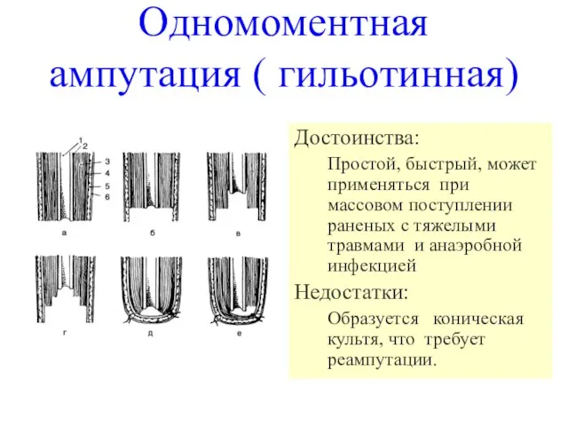 Одномоментная ампутация ( гильотинная) Достоинства: Простой, быстрый, может применяться при массовом поступлении