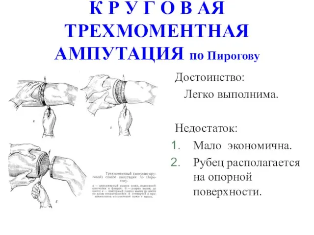 К Р У Г О В АЯ ТРЕХМОМЕНТНАЯ АМПУТАЦИЯ по Пирогову Достоинство: