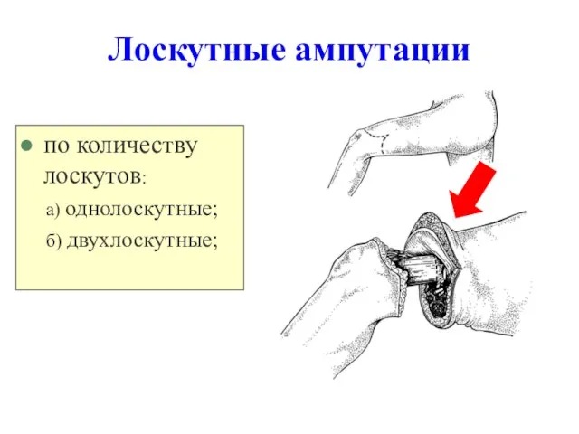 Лоскутные ампутации по количеству лоскутов: а) однолоскутные; б) двухлоскутные;