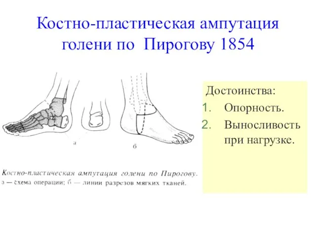 Костно-пластическая ампутация голени по Пирогову 1854 Достоинства: Опорность. Выносливость при нагрузке.