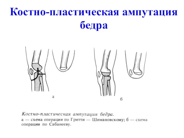 Костно-пластическая ампутация бедра