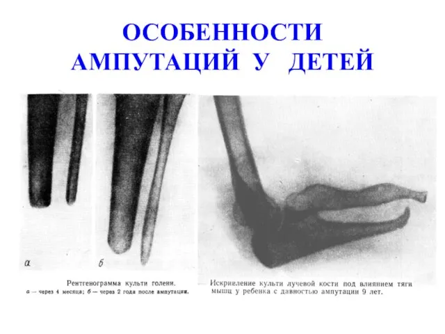 ОСОБЕННОСТИ АМПУТАЦИЙ У ДЕТЕЙ