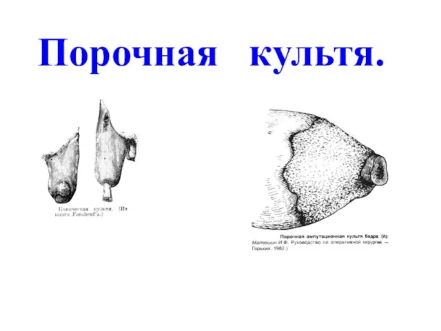 Порочная культя.