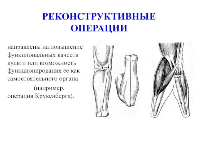 РЕКОНСТРУКТИВНЫЕ ОПЕРАЦИИ направлены на повышение функциональных качеств культи или возможность функционирования ее